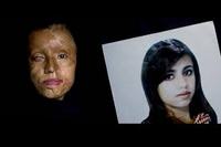 Imagen de apoyo de  Derechos en salud de victimas de ataques con acidos