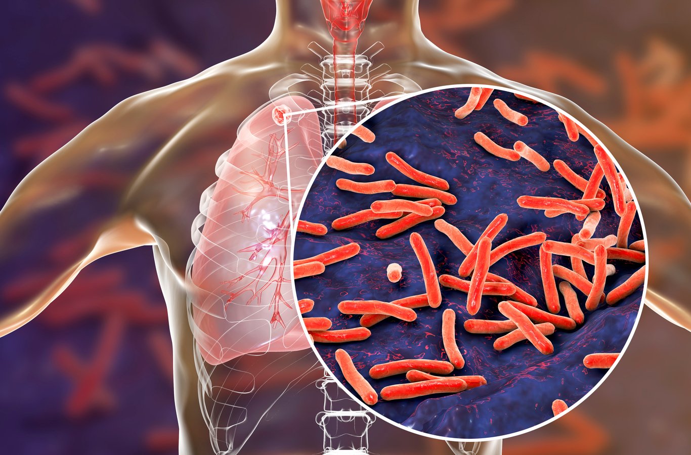 Imagen de apoyo de  Minsalud asigno mas de  7 mil ochocientos millones a programas de tuberculosis