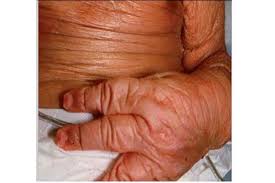 Imagen de apoyo de  Procuraduria General de la Nacion requirio al Ministerio de Salud y Proteccion Social sobre avances frente a la ley de enfermedades huerfanas