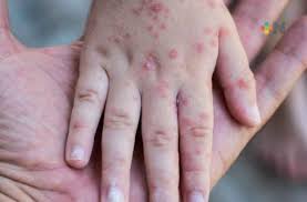 Imagen de apoyo de  Son intensificadas las acciones para contener el dengue y el sarampion en el pais