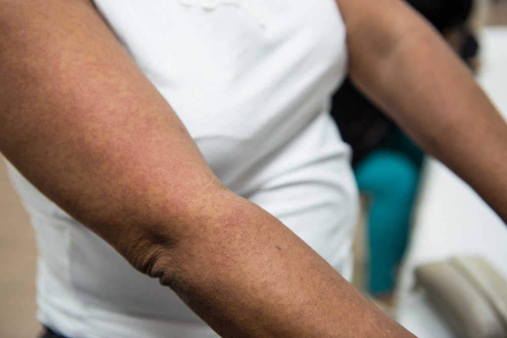 Imagen de apoyo de  OPS moviliza a especialistas ante posible relacion del Zika y la microcefalia